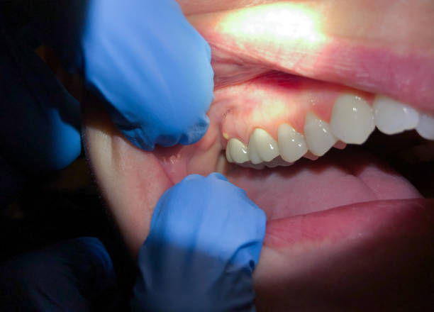 Best Emergency Wisdom Teeth Removal in Greenville, MI